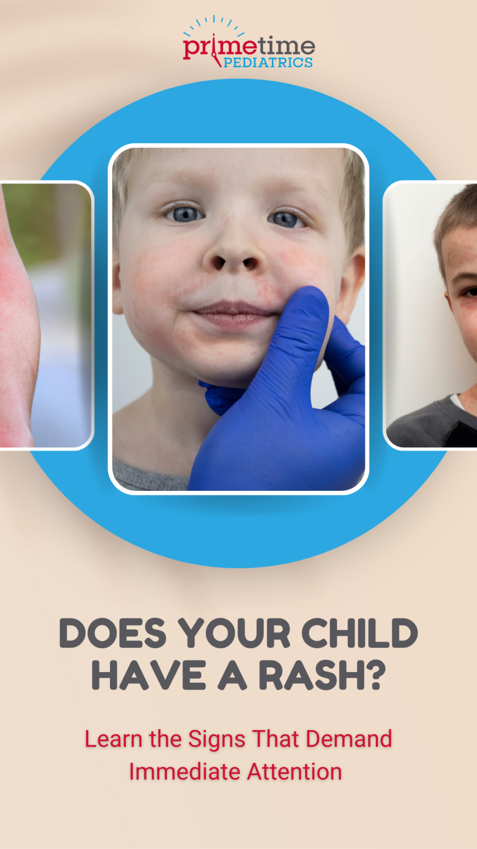 “Spotting” the Difference in Rashes: A Parent’s Guide